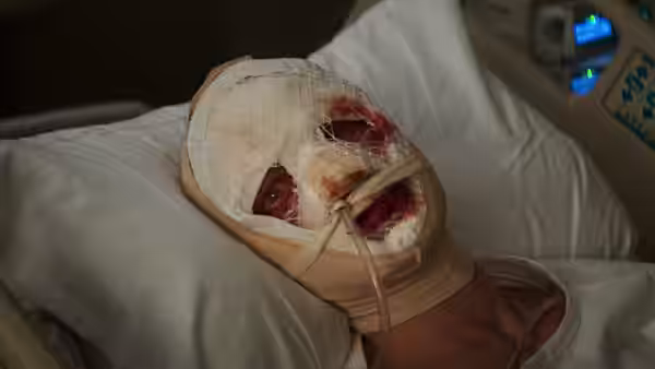 A heavily bandaged patient lies in a hospital bed with a breathing tube